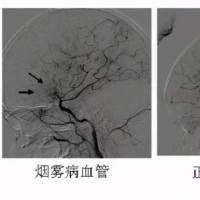 “河南經(jīng)驗(yàn)”寫入最新煙霧病中國專家共識(shí)